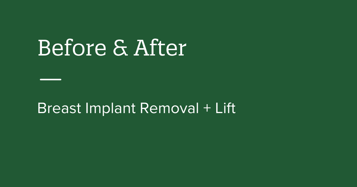 Breast Implant Removal + Lift Before and After Journey 2 Avery